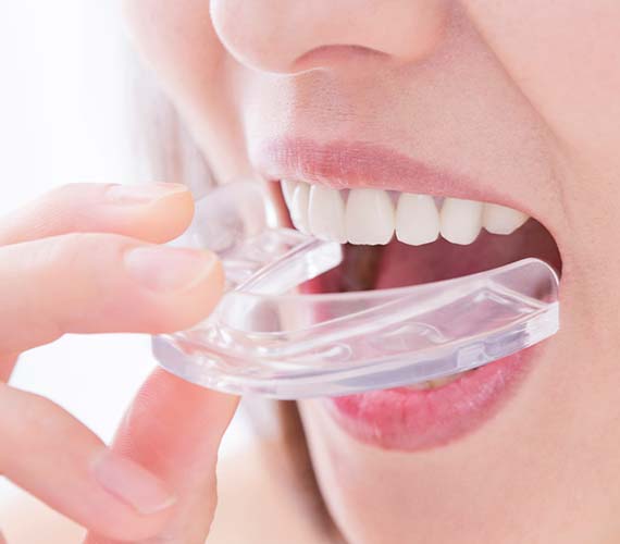 各種マウスピース製作